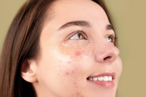 Skincare Tips For Acne
